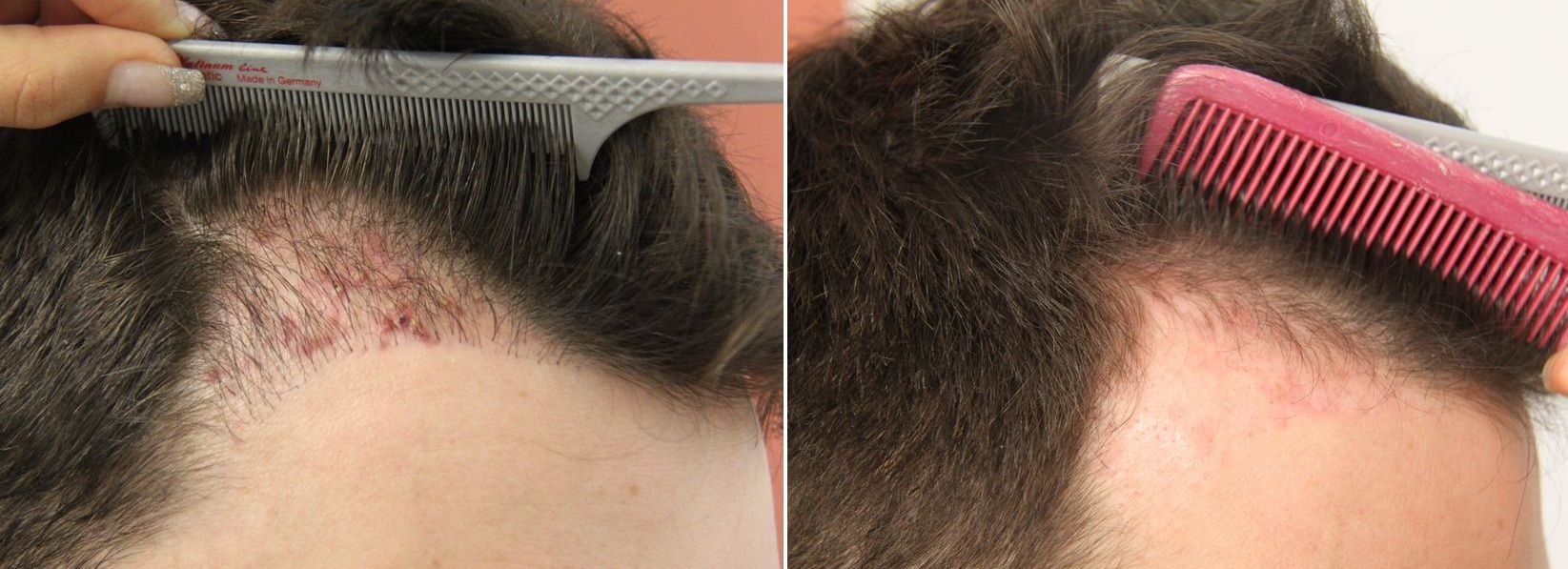 Dr. Bisanga, BHR Clinic Plugs removal Results Posted by Leading